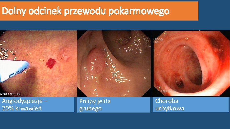 Dolny odcinek przewodu pokarmowego Angiodysplazje – 20% krwawień Polipy jelita grubego Choroba uchyłkowa 