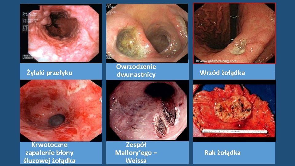 Żylaki przełyku Owrzodzenie dwunastnicy Wrzód żołądka Krwotoczne zapalenie błony śluzowej żołądka Zespół Mallory’ego –