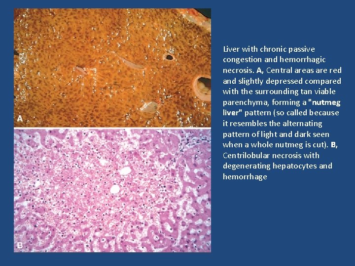 Liver with chronic passive congestion and hemorrhagic necrosis. A, Central areas are red and