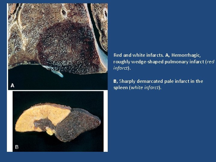 Red and white infarcts. A, Hemorrhagic, roughly wedge-shaped pulmonary infarct (red infarct). B, Sharply