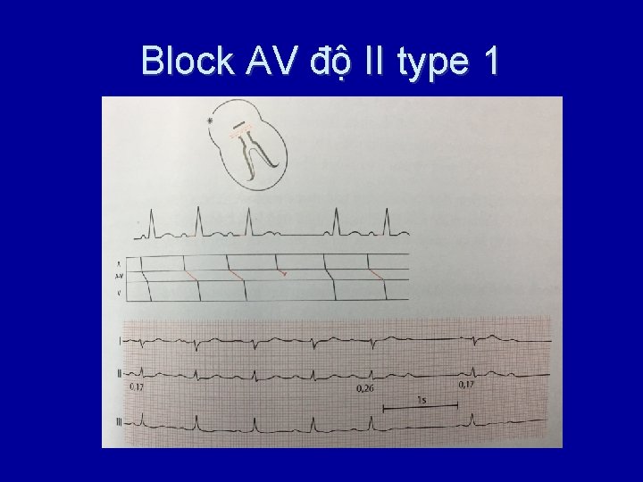 Block AV độ II type 1 