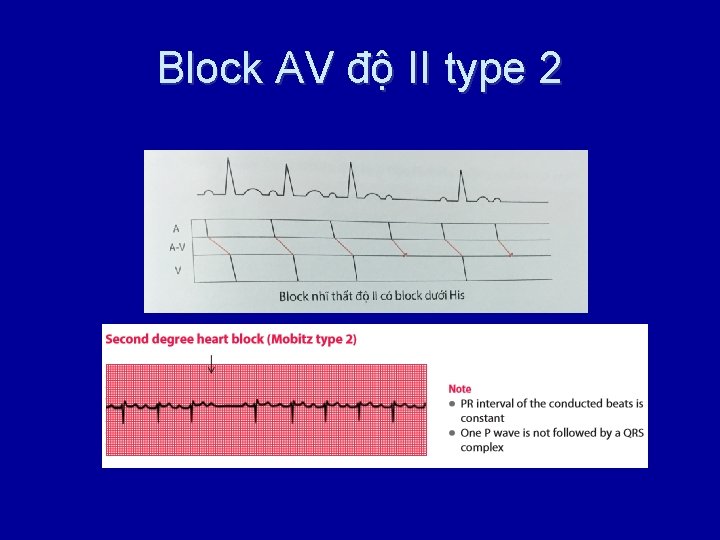 Block AV độ II type 2 