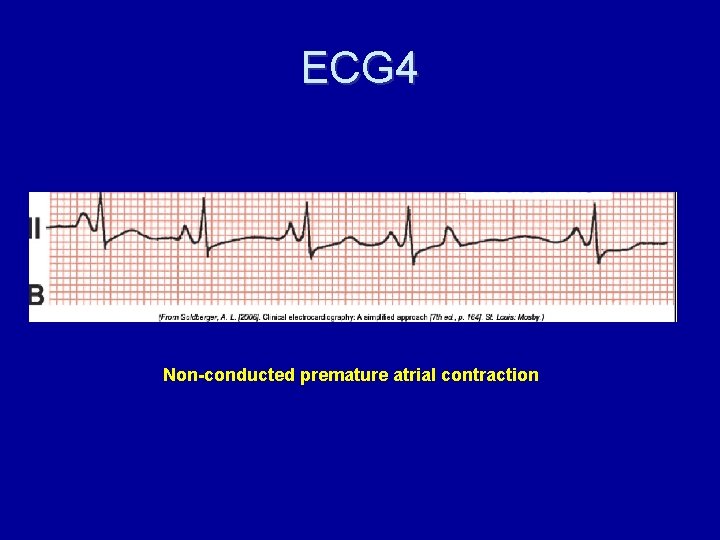 ECG 4 Non-conducted premature atrial contraction 