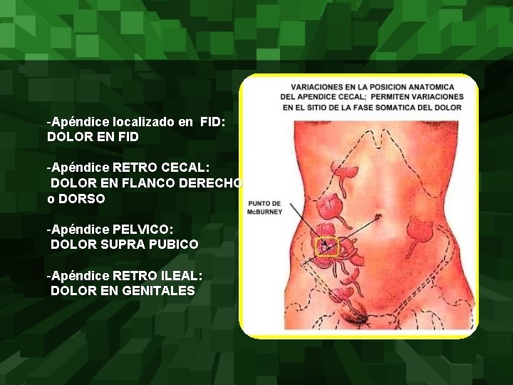 -Apéndice localizado en FID: DOLOR EN FID -Apéndice RETRO CECAL: DOLOR EN FLANCO DERECHO