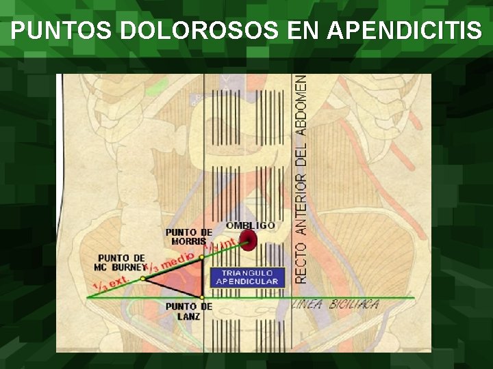 PUNTOS DOLOROSOS EN APENDICITIS 