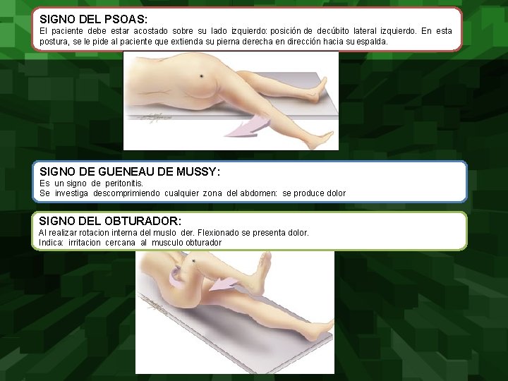 SIGNO DEL PSOAS: El paciente debe estar acostado sobre su lado izquierdo: posición de