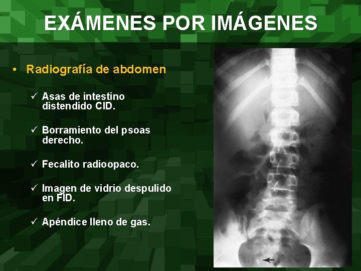 EXÁMENES POR IMÁGENES • Radiografía de abdomen ü Asas de intestino distendido CID. ü