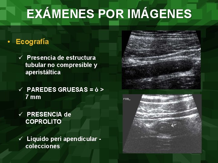 EXÁMENES POR IMÁGENES • Ecografía ü Presencia de estructura tubular no compresible y aperistáltica