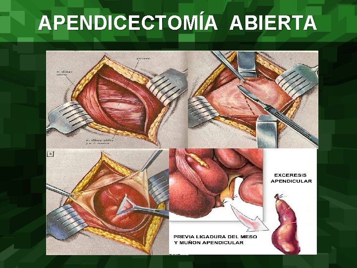 APENDICECTOMÍA ABIERTA 