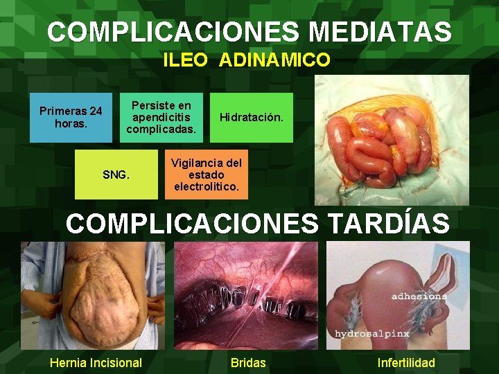COMPLICACIONES MEDIATAS ILEO ADINAMICO Primeras 24 horas. Persiste en apendicitis complicadas. SNG. Hidratación. Vigilancia