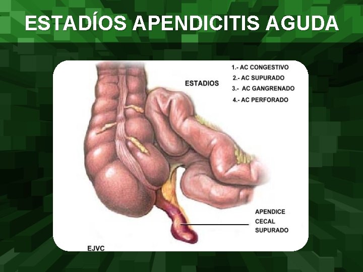 ESTADÍOS APENDICITIS AGUDA 