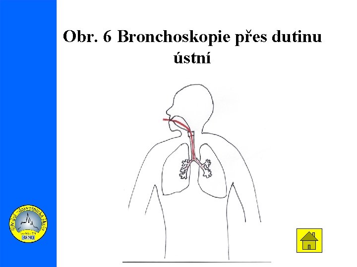 Obr. 6 Bronchoskopie přes dutinu ústní 