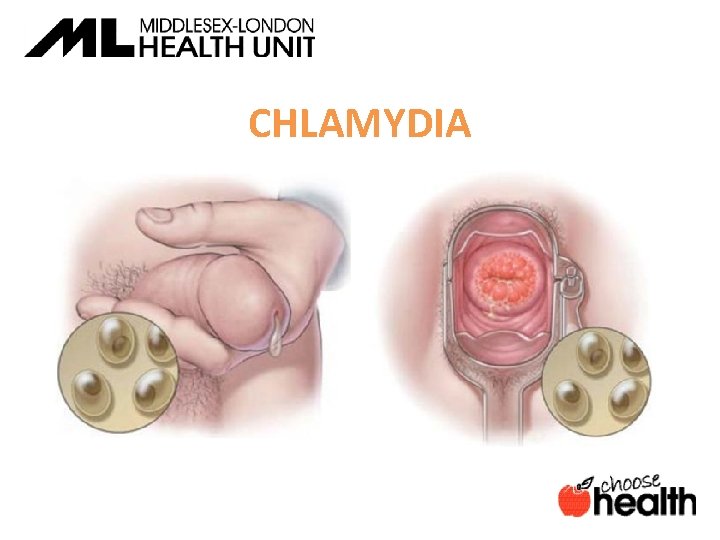CHLAMYDIA 