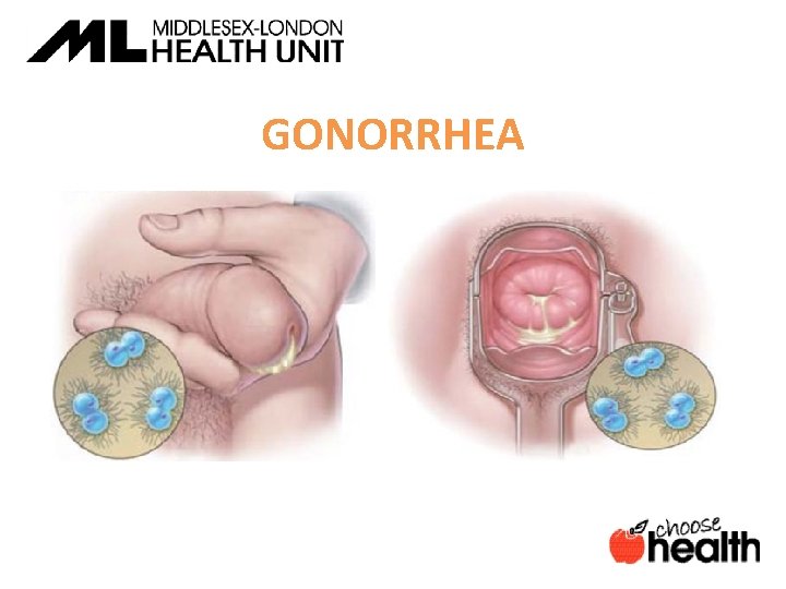 GONORRHEA 