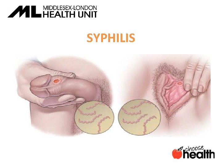 SYPHILIS 