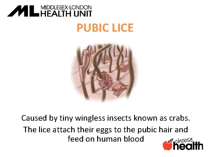 PUBIC LICE Caused by tiny wingless insects known as crabs. The lice attach their