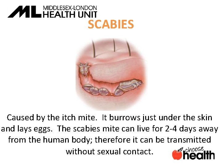 SCABIES Caused by the itch mite. It burrows just under the skin and lays