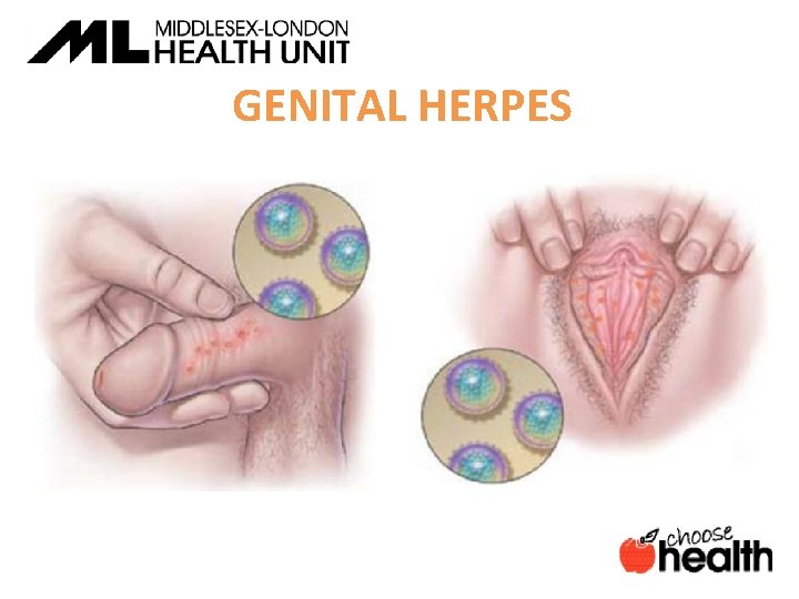 GENITAL HERPES 