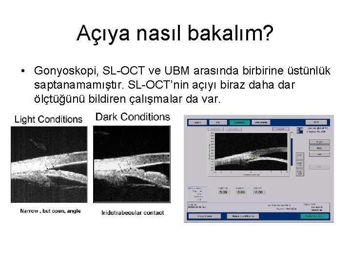 Açıya nasıl bakalım? • Gonyoskopi, SL-OCT ve UBM arasında birbirine üstünlük saptanamamıştır. SL-OCT’nin açıyı