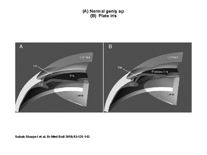 (A) Normal geniş açı (B) Plato iris Subak-Sharpe I et al. Br Med Bull