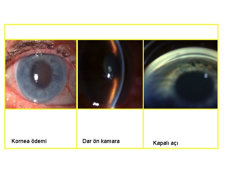 Kornea ödemi Dar ön kamara Kapalı açı 