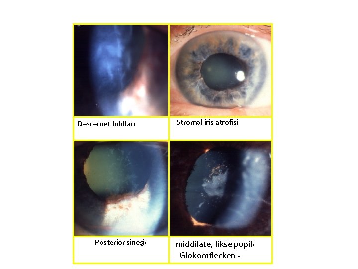 Descemet foldları Posterior sineşi • Stromal iris atrofisi middilate, fikse pupil • Glokomflecken •