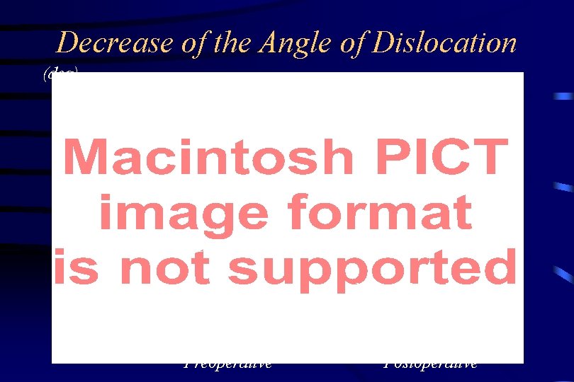 Decrease of the Angle of Dislocation (deg) Mean 216. 7 deg. Mean 136. 4