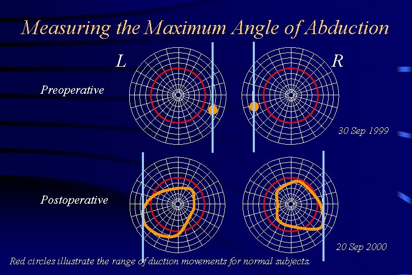 Measuring the Maximum Angle of Abduction L R Preoperative 30 Sep 1999 Postoperative 20