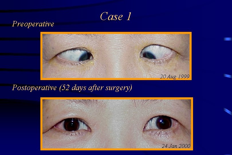 Preoperative Case 1 20 Aug 1999 Postoperative (52 days after surgery) 24 Jan 2000