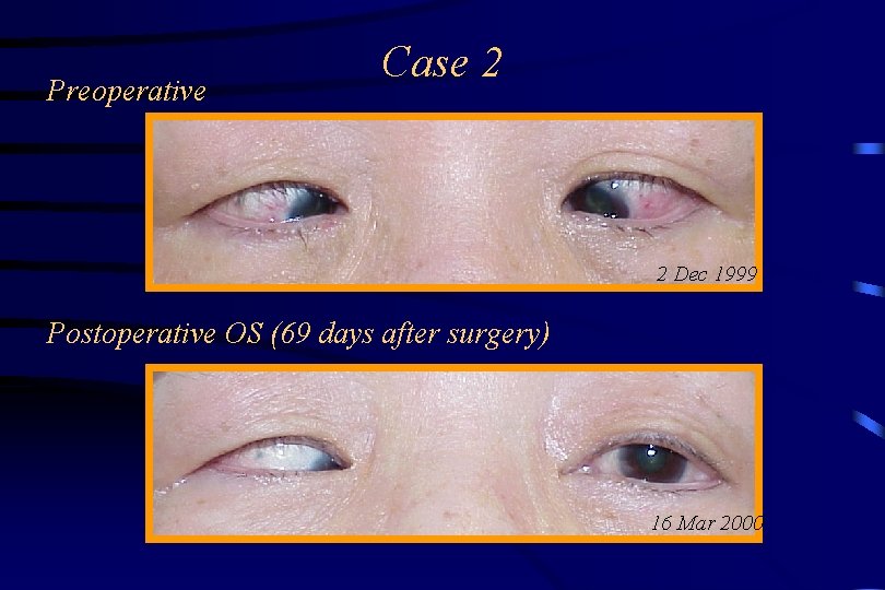 Preoperative Case 2 2 Dec 1999 Postoperative OS (69 days after surgery) 16 Mar
