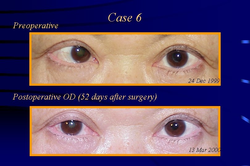 Preoperative Case 6 24 Dec 1999 Postoperative OD (52 days after surgery) 13 Mar