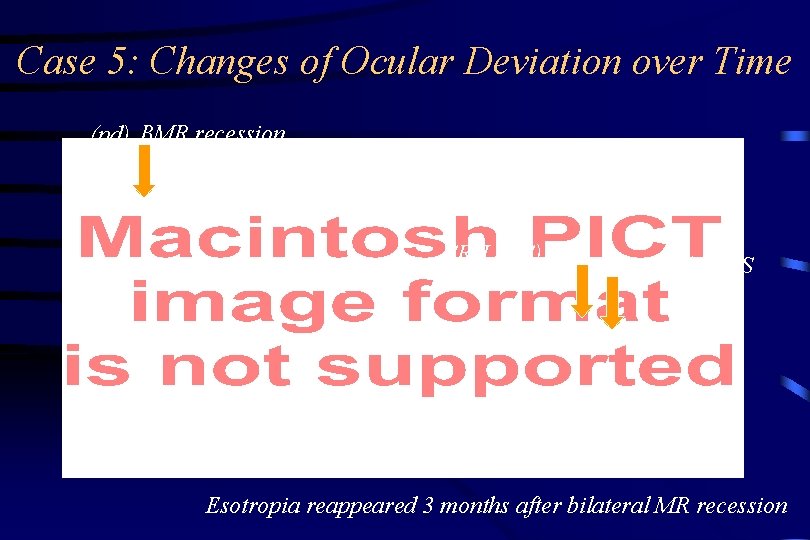 Case 5: Changes of Ocular Deviation over Time (pd) BMR recession 85 pd SR-LR