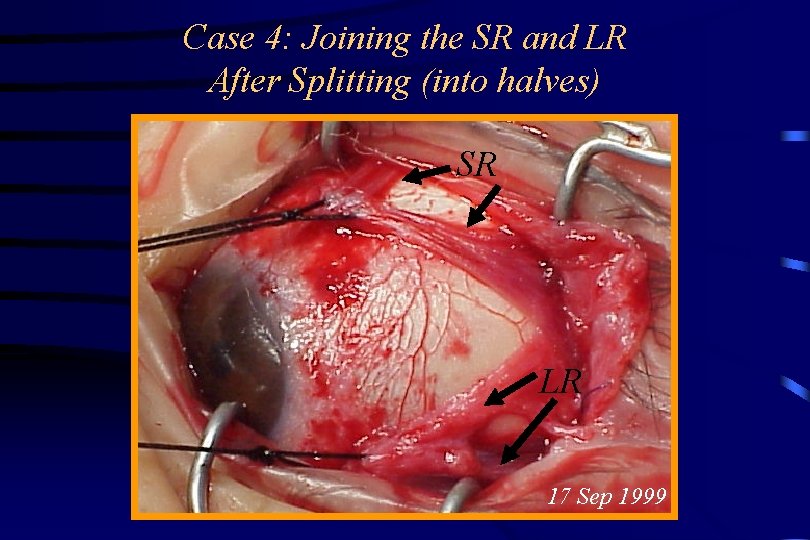Case 4: Joining the SR and LR After Splitting (into halves) SR LR 17