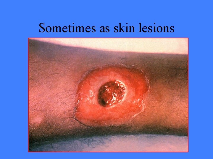 Sometimes as skin lesions 