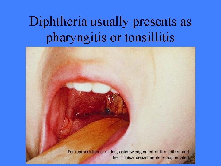 Diphtheria usually presents as pharyngitis or tonsillitis 