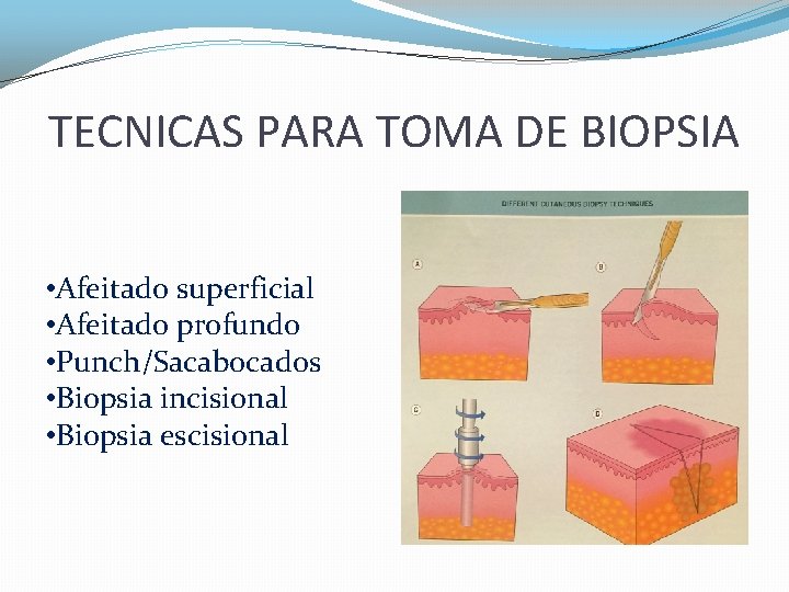 TECNICAS PARA TOMA DE BIOPSIA • Afeitado superficial • Afeitado profundo • Punch/Sacabocados •