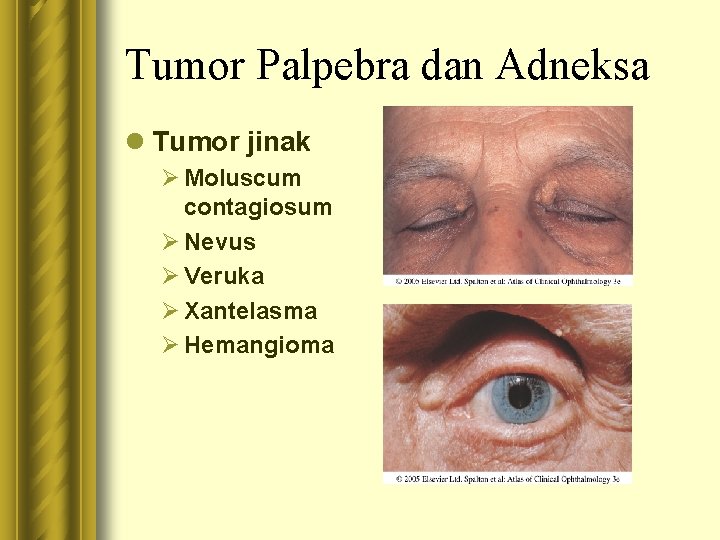 Tumor Palpebra dan Adneksa l Tumor jinak Ø Moluscum contagiosum Ø Nevus Ø Veruka