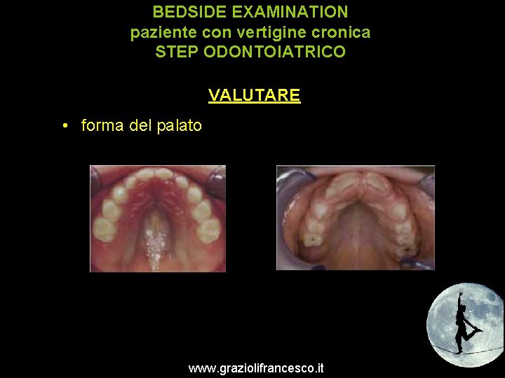 BEDSIDE EXAMINATION paziente con vertigine cronica STEP ODONTOIATRICO VALUTARE • forma del palato www.