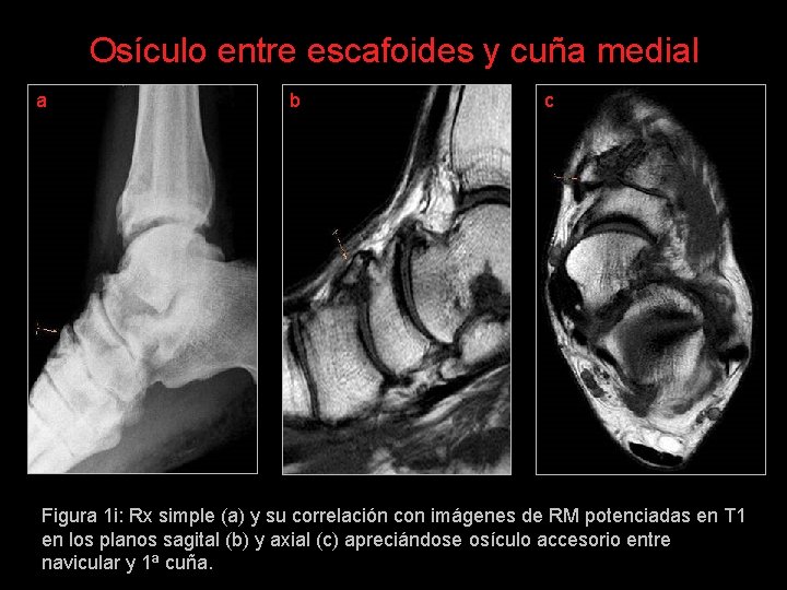 Osículo entre escafoides y cuña medial a b c Figura 1 i: Rx simple
