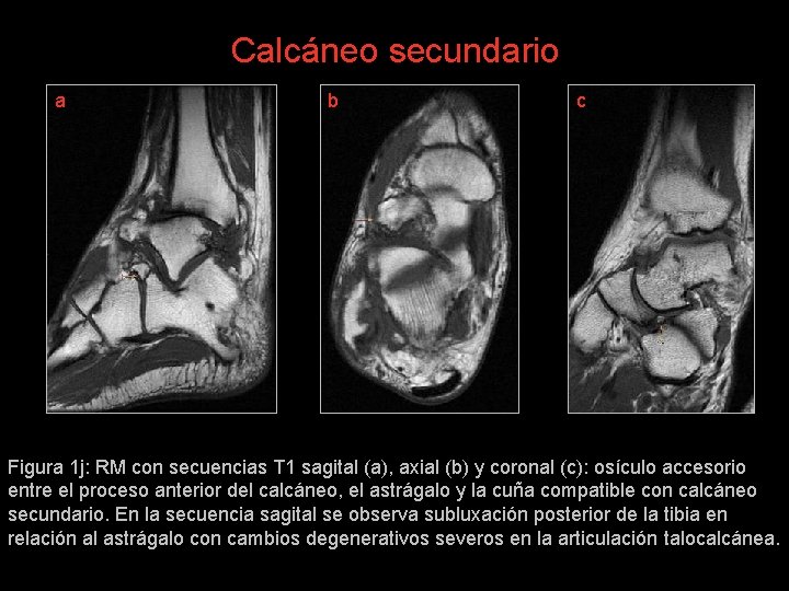 Calcáneo secundario a b c Figura 1 j: RM con secuencias T 1 sagital