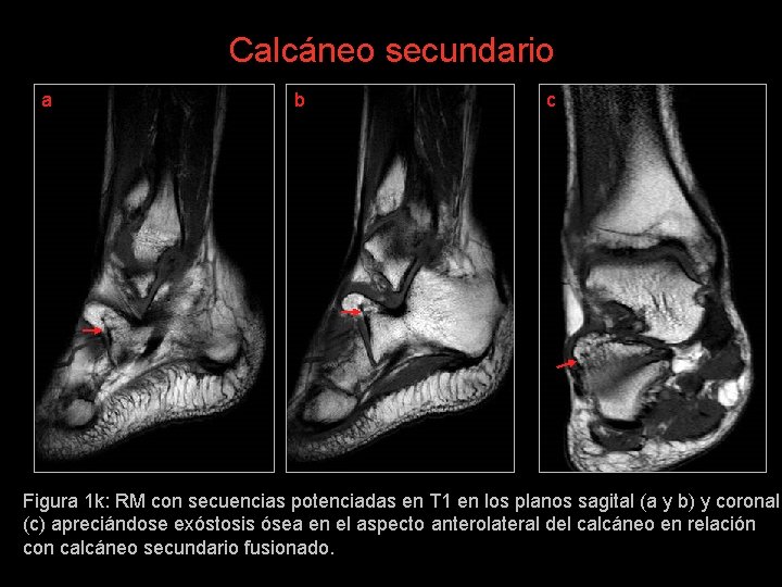 Calcáneo secundario a b c Figura 1 k: RM con secuencias potenciadas en T