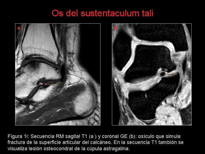 Os del sustentaculum tali a b Figura 1 l: Secuencia RM sagital T 1