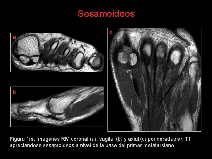 Sesamoideos a c b Figura 1 m: Imágenes RM coronal (a), sagital (b) y