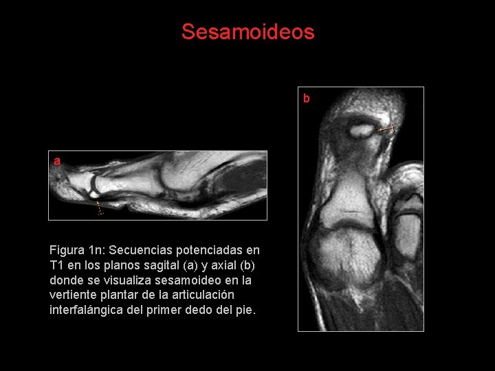 Sesamoideos b a Figura 1 n: Secuencias potenciadas en T 1 en los planos