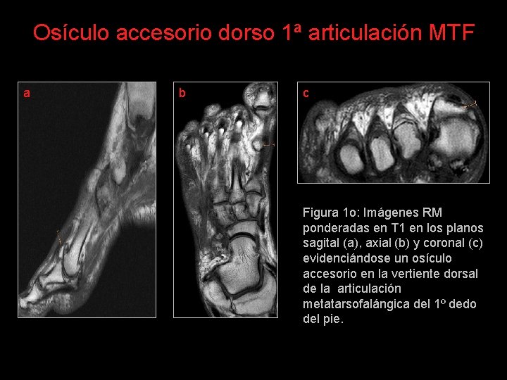 Osículo accesorio dorso 1ª articulación MTF a b c Figura 1 o: Imágenes RM