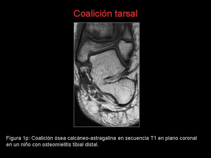 Coalición tarsal Figura 1 p: Coalición ósea calcáneo-astragalina en secuencia T 1 en plano