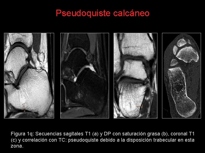 Pseudoquiste calcáneo Figura 1 q: Secuencias sagitales T 1 (a) y DP con saturación