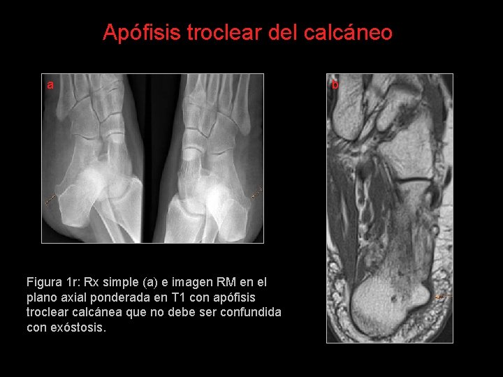 Apófisis troclear del calcáneo a Figura 1 r: Rx simple (a) e imagen RM