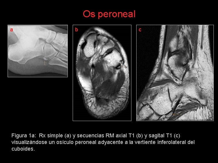 Os peroneal a b c Figura 1 a: Rx simple (a) y secuencias RM