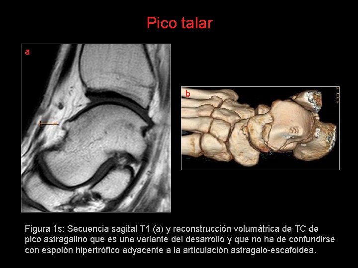 Pico talar a b Figura 1 s: Secuencia sagital T 1 (a) y reconstrucción